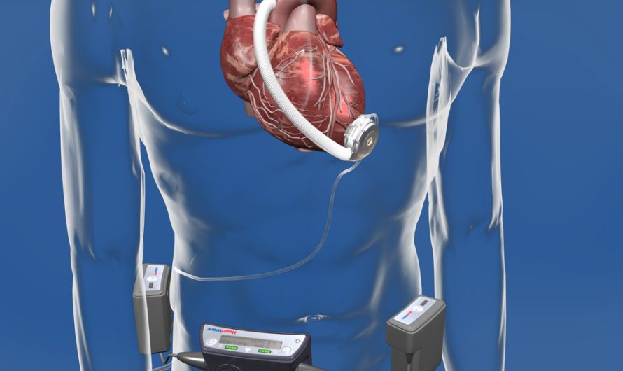 Increasing Cardiovascular Diseases in the World Are Augmenting the Growth of the Global Cardiac Assist Devices Market