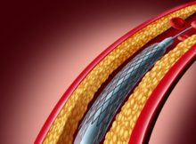 India Coronary Stents Market Is Estimated To Witness High Growth Owing To Increasing Prevalence of Cardiovascular Diseases.