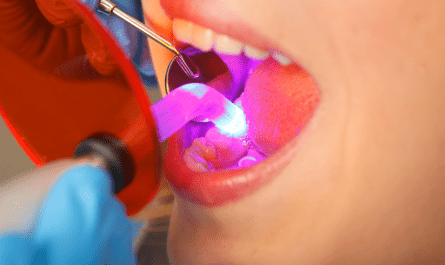 Dental Polymerization Lamps Market
