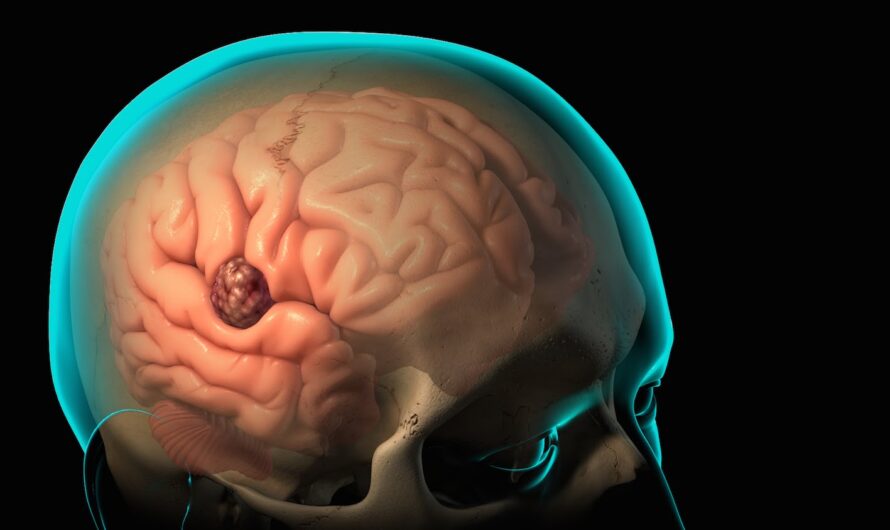 AI Technology Revolutionizes Brain Tumor Diagnosis During Surgery