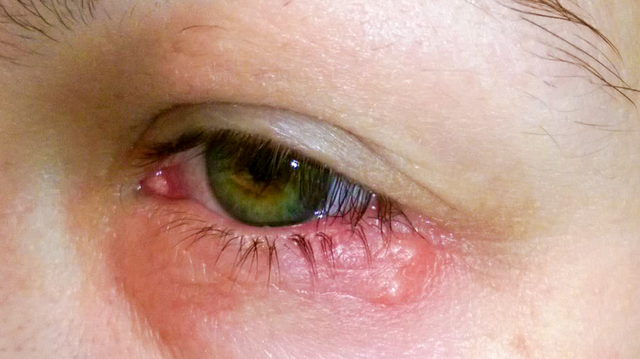 Rare Eye Infection