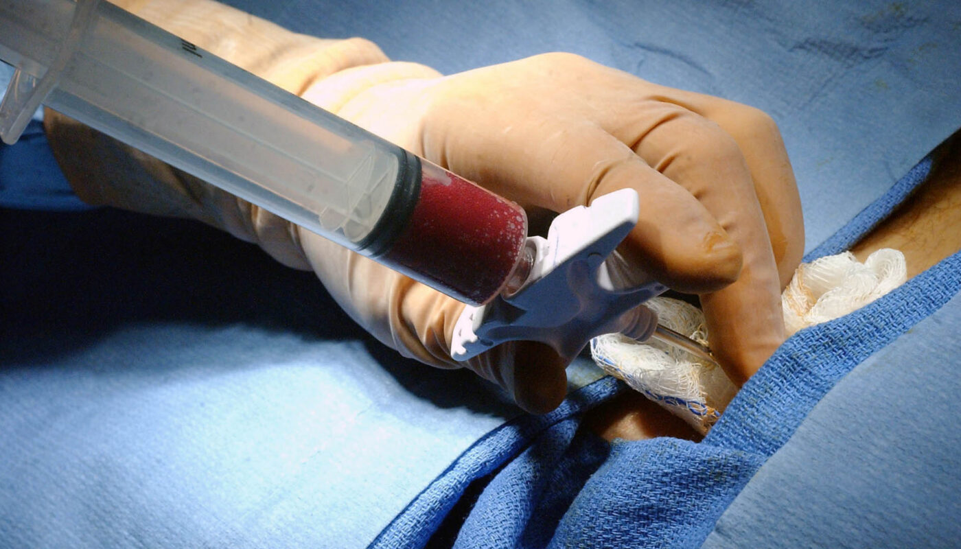 Bone Marrow Transplant Market Is Estimated To Witness High Growth Owing To Technological