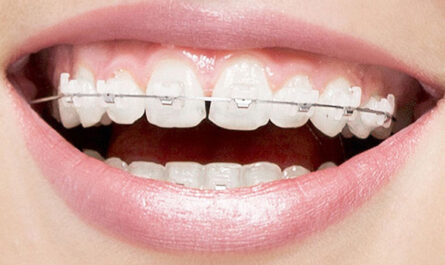 Clear Aligners Market