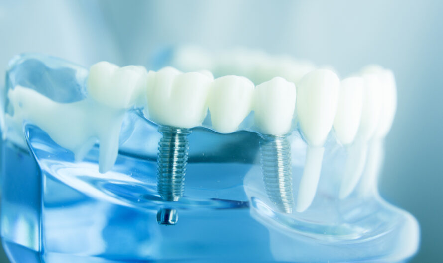 Dental Implants Market is Estimated To Witness High Growth Owing To Rapidly Increasing Patient Pool for Dental Care Across The Globe
