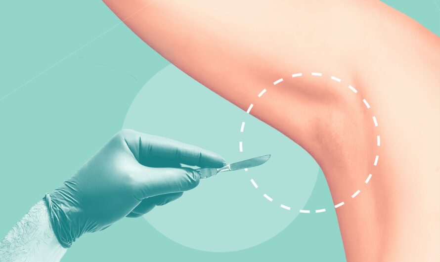 The Increasing Demand For Minimally Invasive Treatments For Hyperhidrosis Is Anticipated To Openup The New Avenue For The Hyperhidrosis Treatment Market