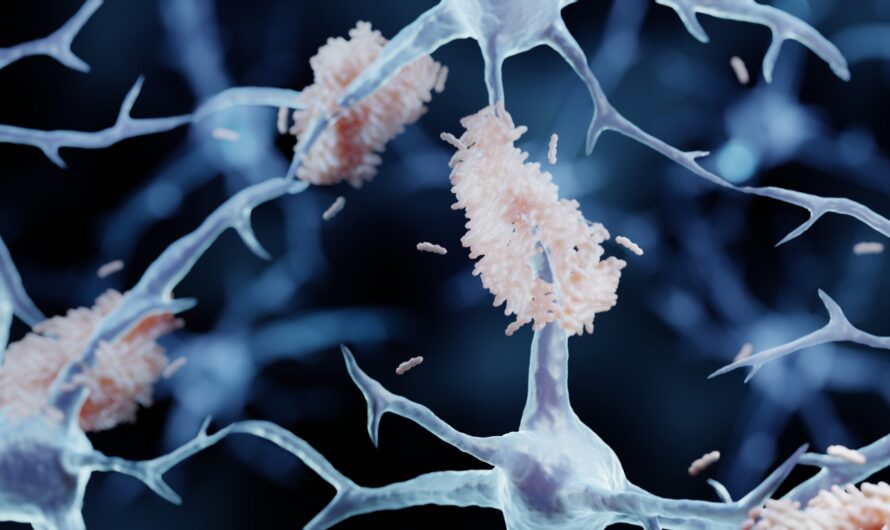 New Study Reveals Amyloid Oligomers’ Role in Early Alzheimer’s Development