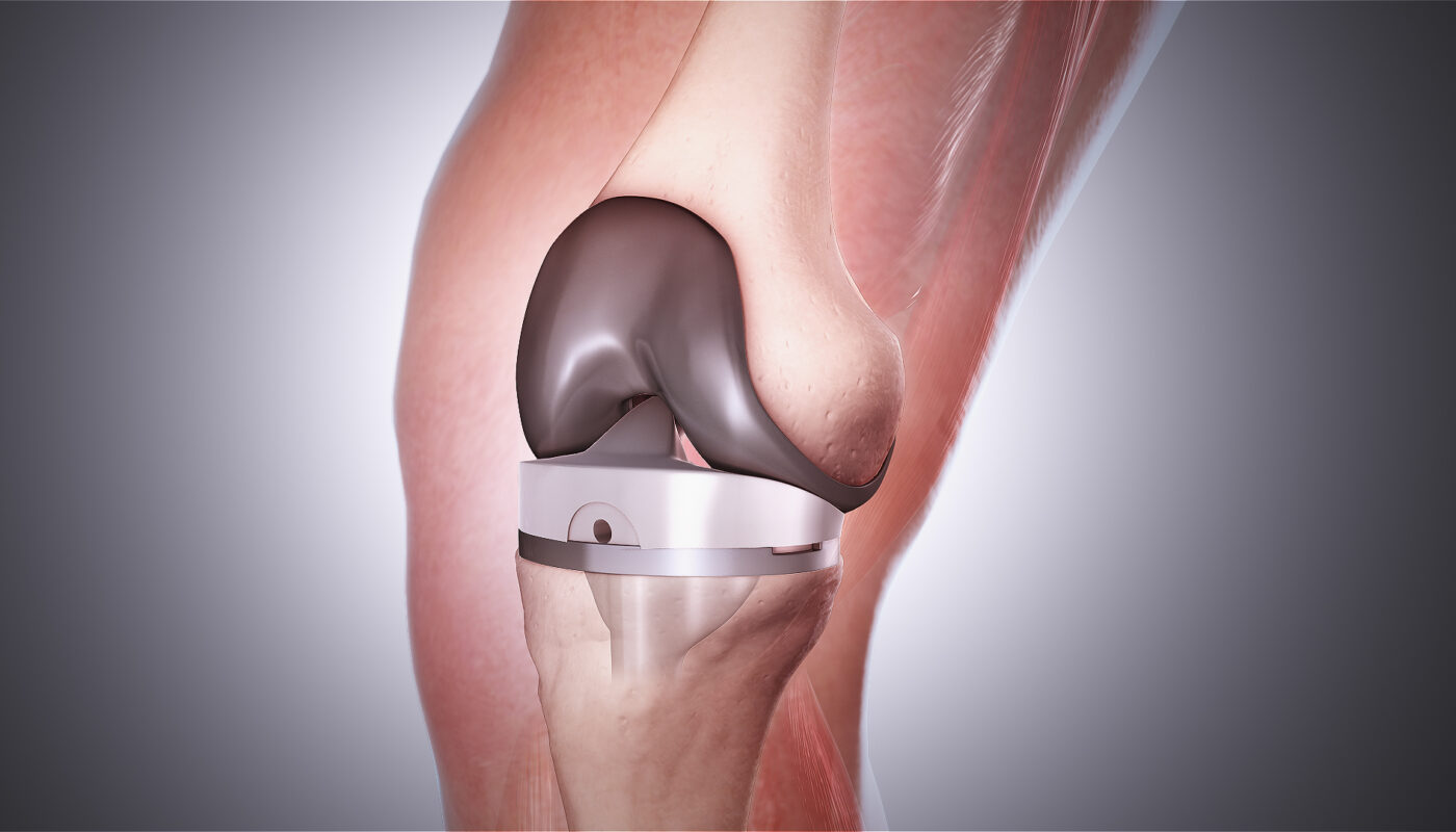 Total Knee Arthroplasty Market