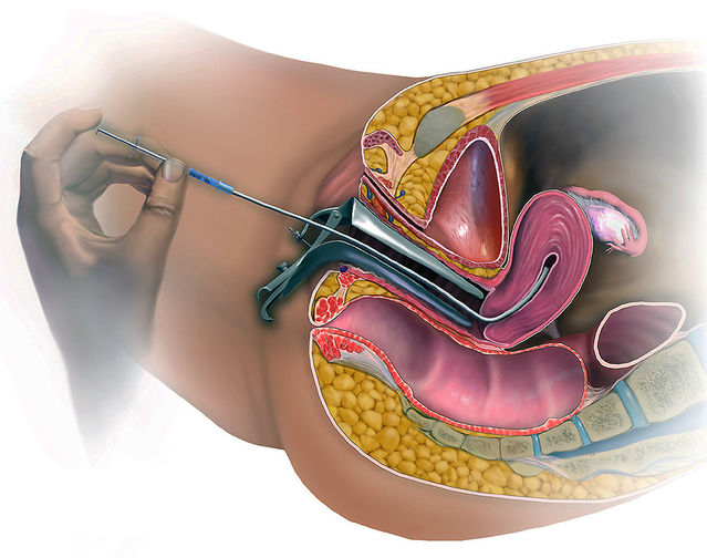 The Global Artificial Insemination Market Is Estimated To Propelled By Increased Demand For Assisted Reproductive Technology