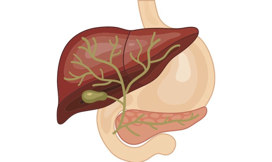 Bile Duct Cancer Market Is Expected To Be Flourished By Rising Prevalence Rate Of Cholelithiasis