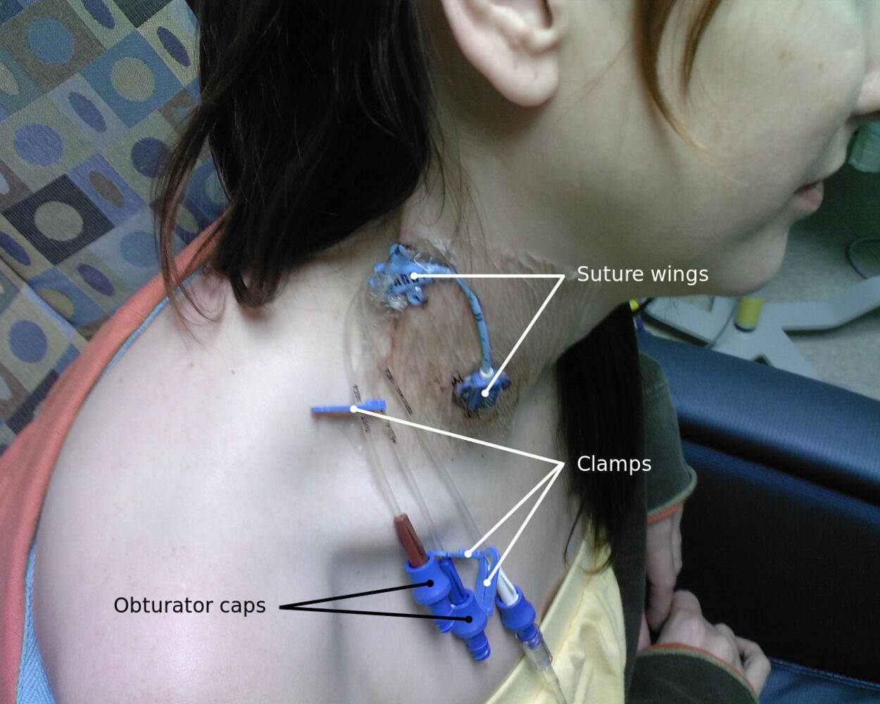 Central Venous Catheter Market Demand Analysis