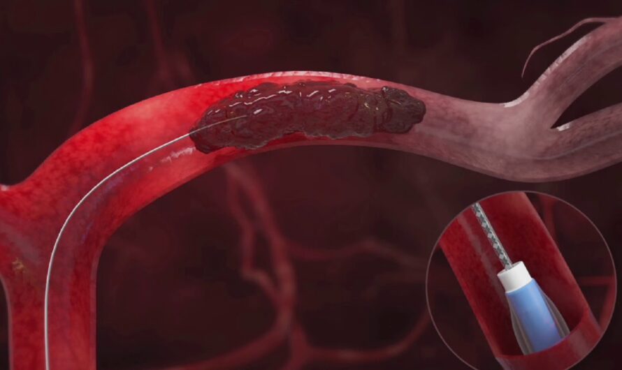 The Vascular Embolization Market is Expected to be Flourished by Growing Adoption of Minimally Invasive Surgical Procedures