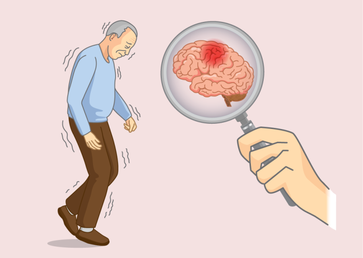 Groundbreaking Blood Test for Alzheimer’s Disease Promises Comprehensive Diagnosis and Management