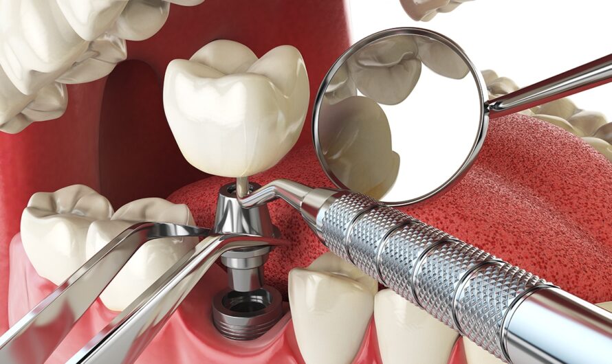 Dental Implants: A Long Lasting Solution for Missing Teeth