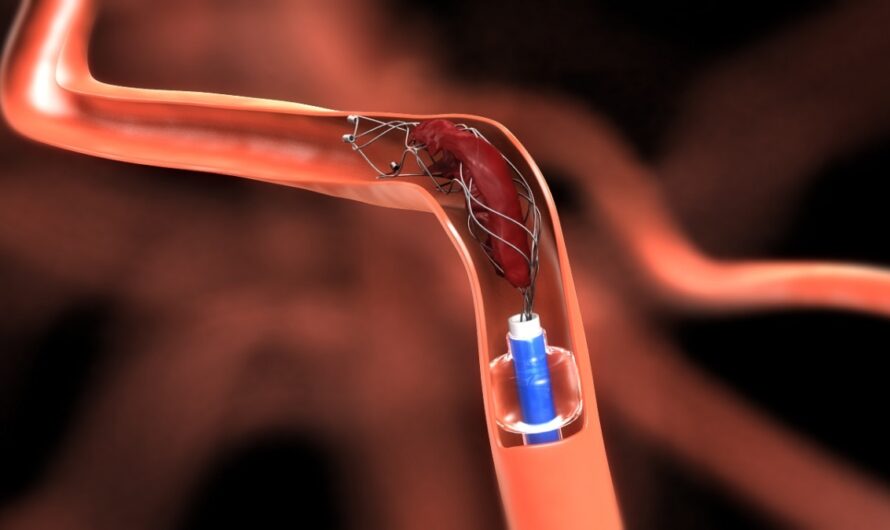 Neurovascular Devices Market Trends By The Rising Prevalence Of Neurovascular Disorders