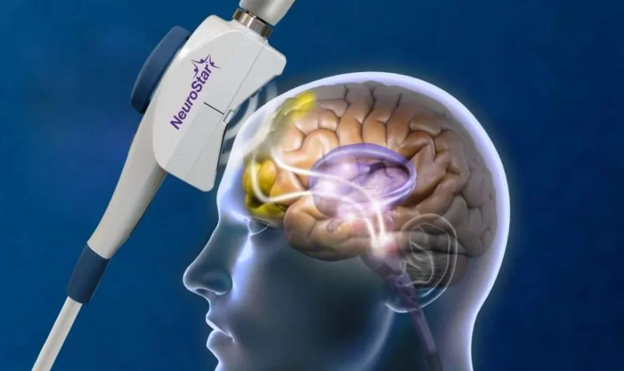 Understanding Transcranial Magnetic Stimulation Therapy and Its Role in Treating Depression