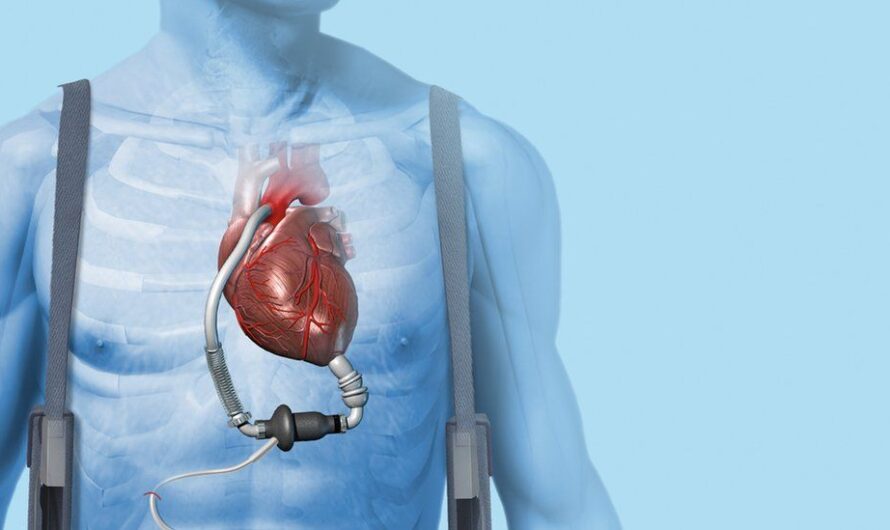Cardiac Assist Devices Market is Transforming Healthcare System by Reducing Heart Disease Burden