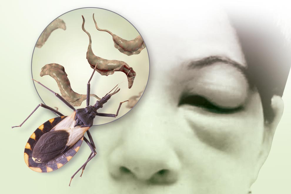 Chagas Disease Treatment Market