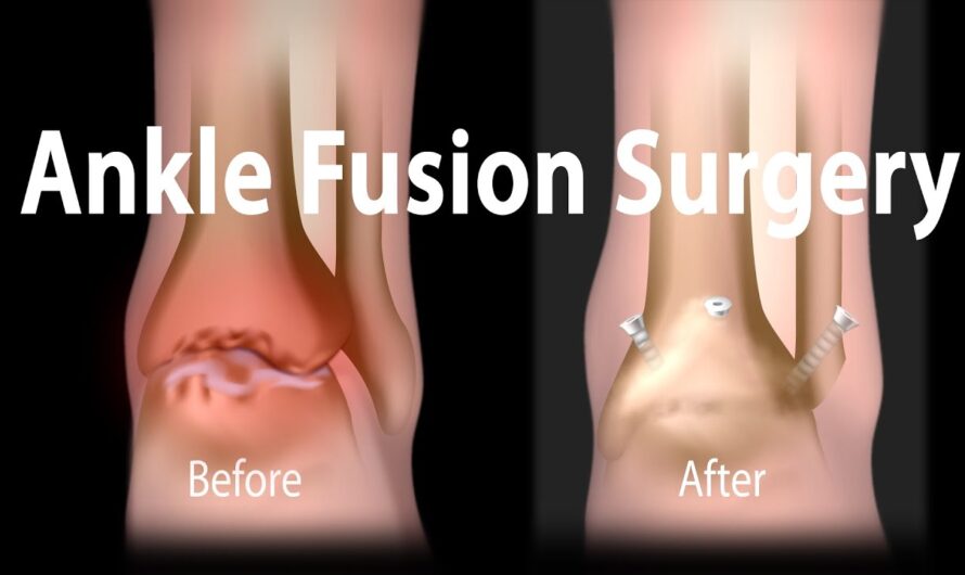 Global Ankle Fusion Nail Market Is Estimated to Witness High Growth Owing To Rising Number of Orthopaedic Surgeriess