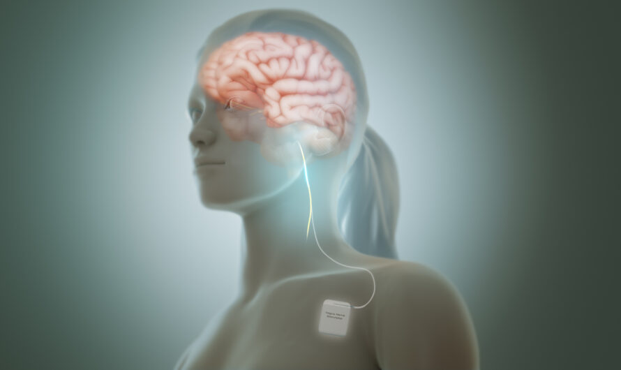 Tapping into Healing: The Promise of Vagus Nerve Stimulators