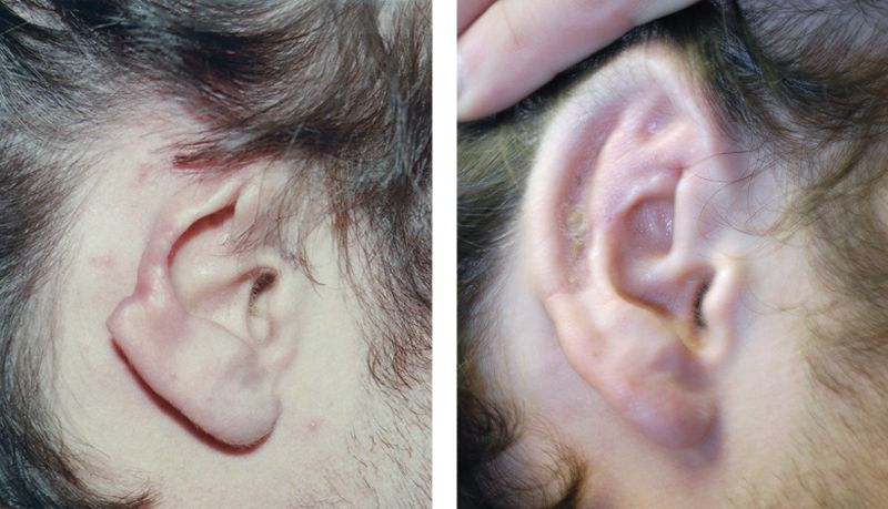 Revolutionary Technology in Ear Reconstruction: Researchers Successfully Replicate Human Ear Grafts